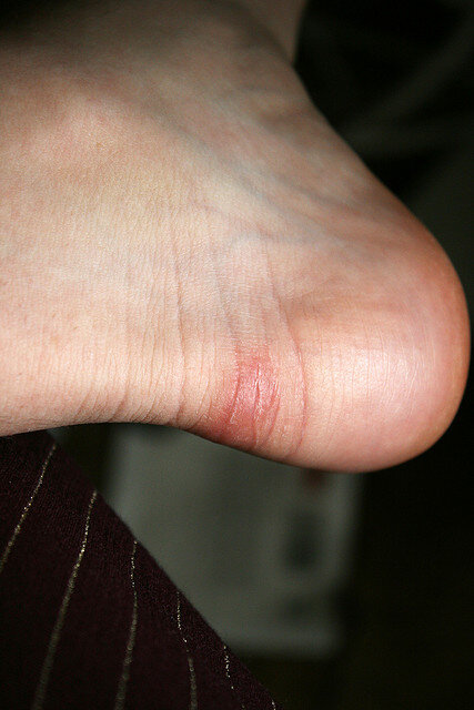 foot blister